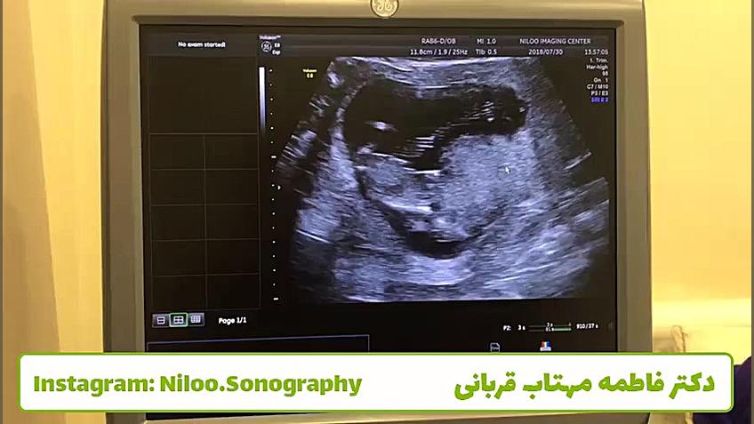 سونوگرافی جنین - آیا بند ناف جنین به ناف مادر متصل است؟ سونوگرافی نیلو دکتر فاطمه مهتاب قربانی