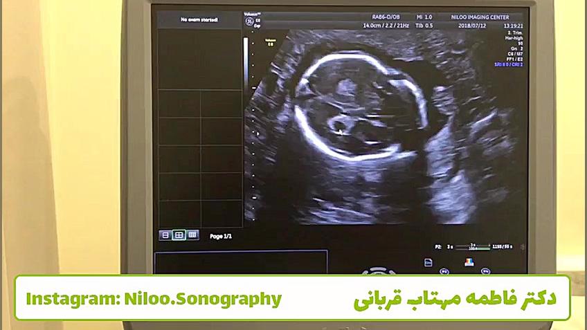 سونوگرافی جنین - وجود توده در جسم پینه ای مغز جنین سونوگرافی نیلو دکتر فاطمه مهتاب قربانی