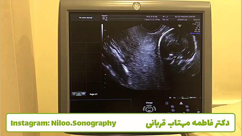 سونوگرافی جنین - اندازه گیری طول سرویکس سونوگرافی نیلو دکتر فاطمه مهتاب قربانی
