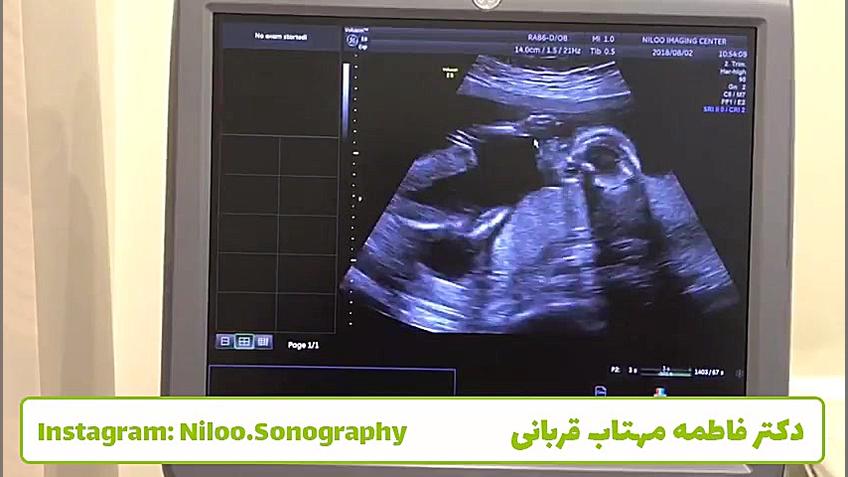 سونوگرافی جنین - نفس کشیدن جنین سونوگرافی نیلو دکتر فاطمه مهتاب قربانی