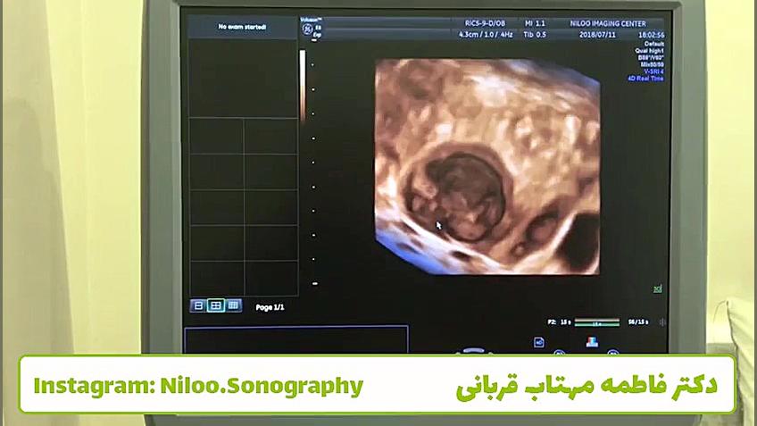 سونوگرافی تخمدان سونوگرافی نیلو دکتر فاطمه مهتاب قربانی