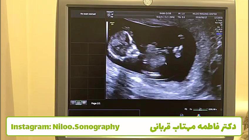 سونوگرافی جنین - تعیین جنسیت در غربالگری اول سونوگرافی نیلو دکتر فاطمه مهتاب قربانی