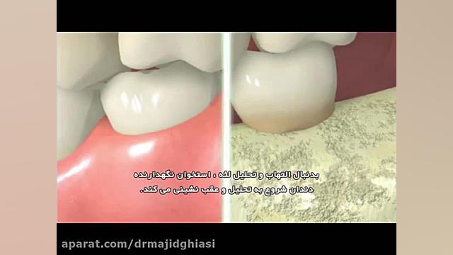 بیماری های لثه -دکترمجیدقیاسی -طبیب الاسنان فی مشهد دکترمجیدقیاسی