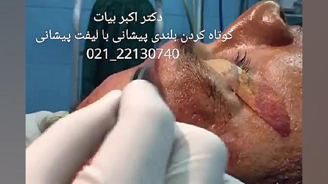 اصلاح پیشانی برجسته - لیفت ابرو و کوتاه کردن پیشانی ایمونولوژی محاسباتی