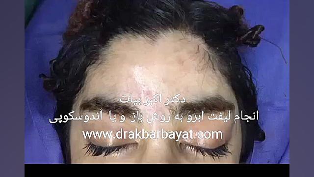 لیفت ابرو با جراحی و بشکل دائمی ابمابوسیکلیب