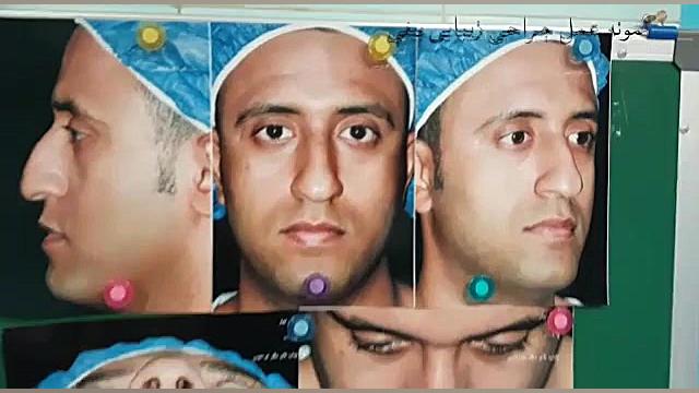 جراحی بینی گوشتی توسط دکتر امید ابراهیمی دکتر امید ابراهیمی