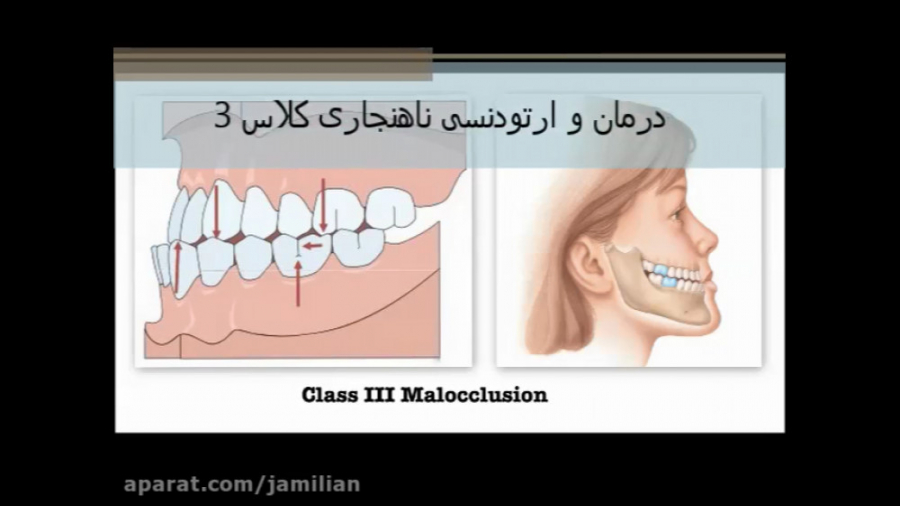 همه چیز درباره ارتودنسی ناهنجاری کلاس 3 دکتر عبدالرضا جمیلیان - متخصص ارتودنسی