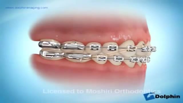 استفاده از الاستیکهای بین فکی دکتر سهیل سالاری