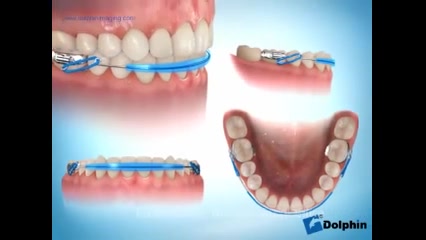retainer متحرک دکتر سهیل سالاری