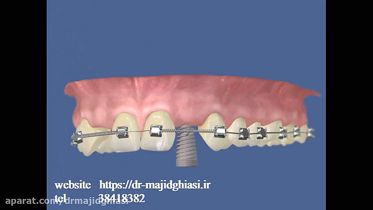 ایمپلنت دندان -دکترمجیدقیاسی دکترمجیدقیاسی