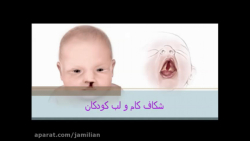 درمان لب شکری شکاف کام و لب