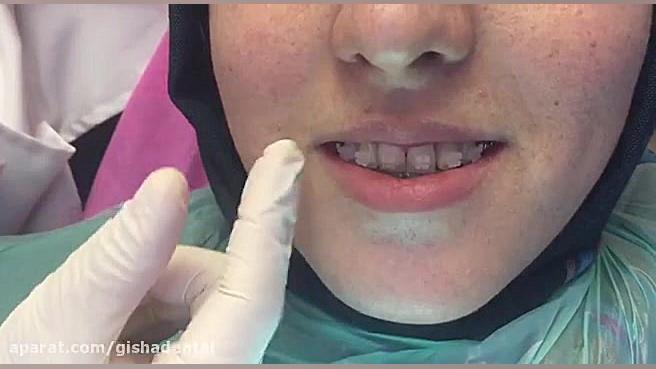 ارتودنسی نامرئی - براکت سرامیکی کلینیک دندانپزشکی دکتر عزیز گشاده رو