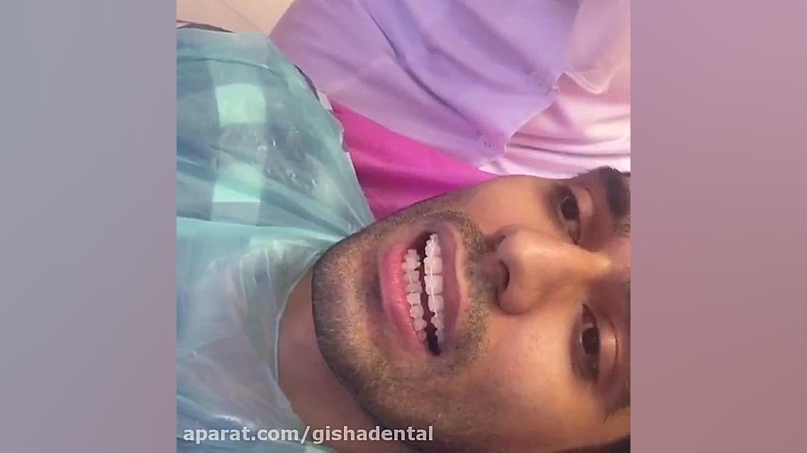 ارتودنسی نامرئی - براکت سرامیکی کلینیک دندانپزشکی دکتر عزیز گشاده رو