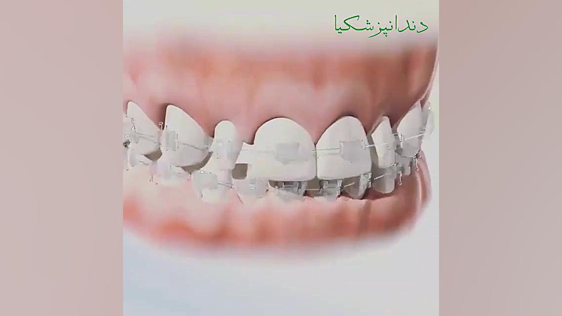 ارتودنسی دندان چگونه دندان ها را مرتب می کند؟ پزشکی کانابینوئید