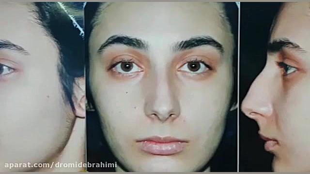 جراحی بینی استخوانی قوز دار توسط دکتر امید ابراهیمی دکتر امید ابراهیمی