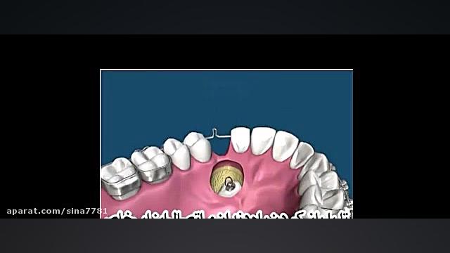ارتودنسی دندان | کلینیک دندانپزشکی تاج تست ایمونوبلات