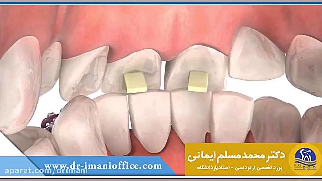 نحوه تنظیم دندان ها برای جلوگیری از انحراف براکت ها دکتر محمد مسلم ایمانی - متخصص ارتودنسی در کرمانشاه