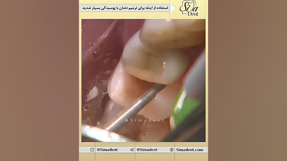 ترمیم اینله در پوسیدگی دندان | دندانپزشکی سیما دنت بیولوژی تکوینی