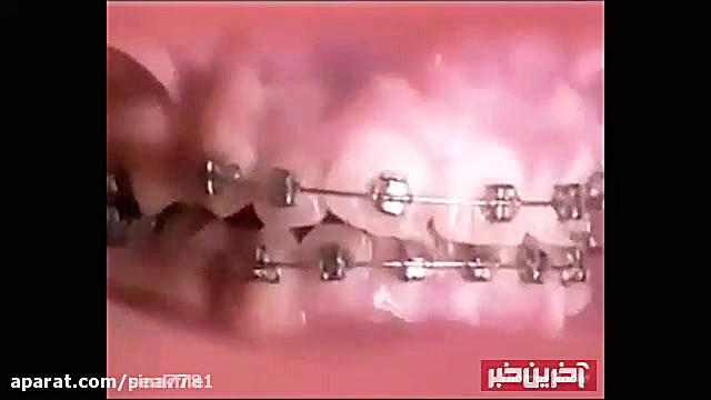 ارتودنسی دندان | کلینیک دندانپزشکی تاج رزولین