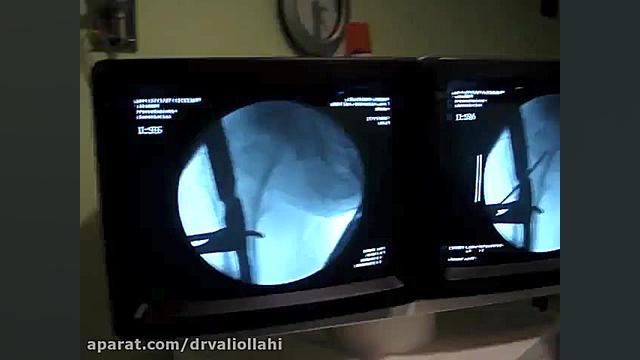 Minimally Invasive Clamp-Assisted Reduction and Cephalo بررسی اروماتاز