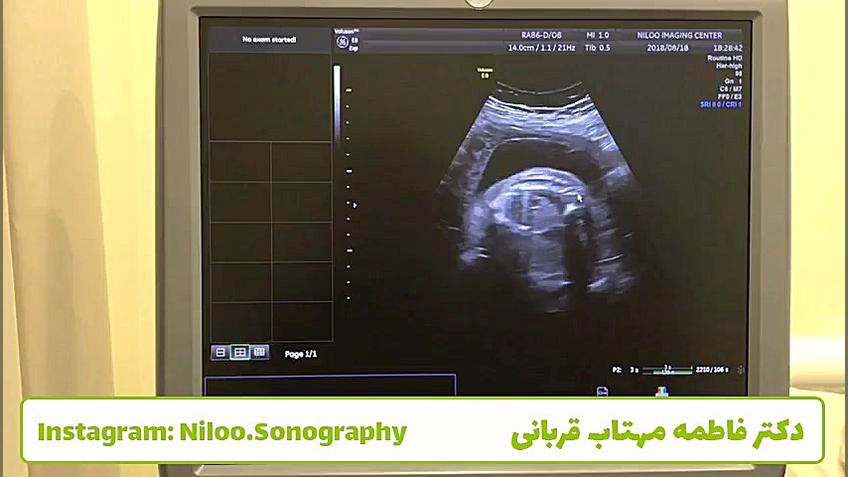 سونوگرافی جنین - ستون فقرات جنین سونوگرافی نیلو دکتر فاطمه مهتاب قربانی