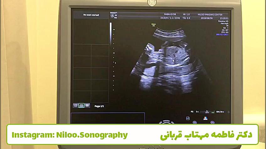 سونوگرافی جنین - غربالگری دوم، بررسی معده جنین سونوگرافی نیلو دکتر فاطمه مهتاب قربانی