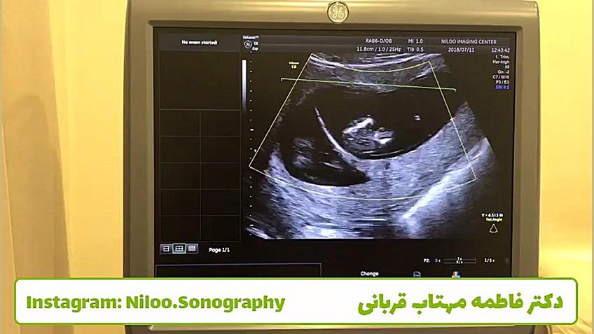 سونوگرافی جنین - دوقلوهای ناهمسان سونوگرافی نیلو دکتر فاطمه مهتاب قربانی