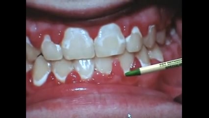 مسواک زدن ارتودنسی دکتر سهیل سالاری