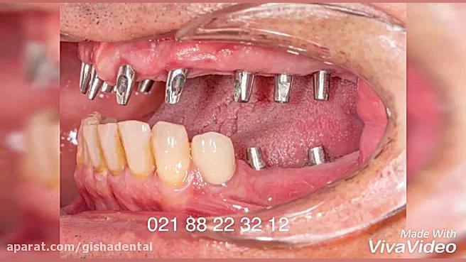 بازسازی کامل دندانهای فک بالا و دندانهای عقبی فک پایین با ایمپلنت کلینیک دندانپزشکی دکتر عزیز گشاده رو