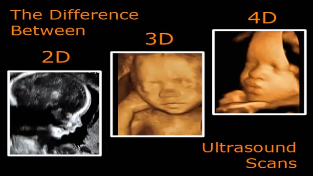 مقایسه ی سونوگرافی 2 و 3 و 4 بعدی هوپیلو