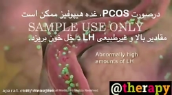 تخمدان پلی کیستیک (تنبلی تخمدا...