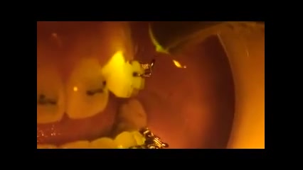 نحوه ی قرار دادن براکت دکتر سهیل سالاری