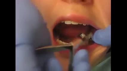 برداشتن براکت ارتودنسی دکتر سهیل سالاری