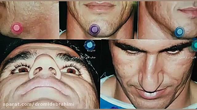 جراحی بینی گوشتی توسط دکتر امید ابراهیمی بهترین جراح دکتر امید ابراهیمی