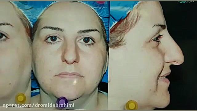 جراحی بینی گوشتی توسط دکتر امید ابراهیمی بهترین جراح دکتر امید ابراهیمی