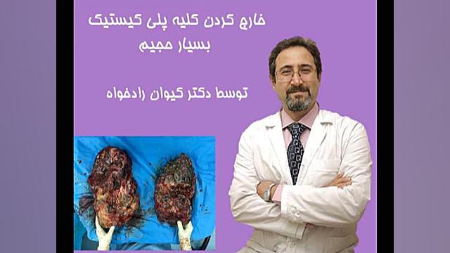 عمل جراحی خارج کردن کلیه پلی کیستیک بسیار حجیم لیزر مو