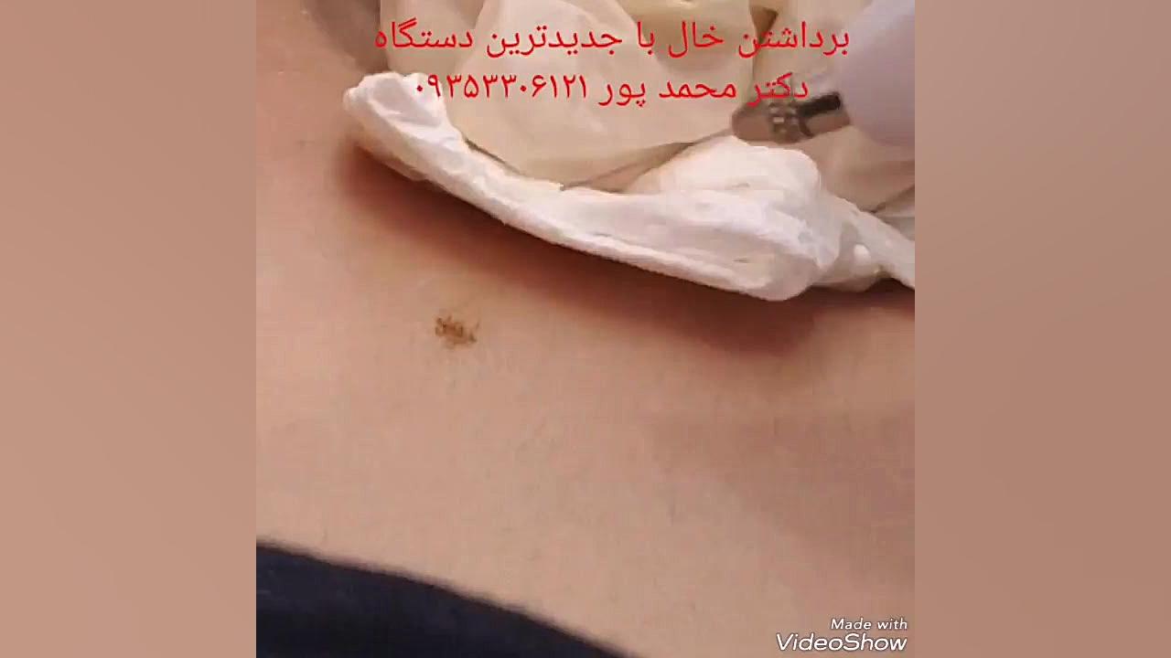 برداشتن انواع خال و ... پیلینگ شیمیایی