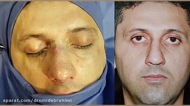 جراحی بینی گوشتی توسط دکتر امید ابراهیمی بهترین جراح بینی دکتر امید ابراهیمی