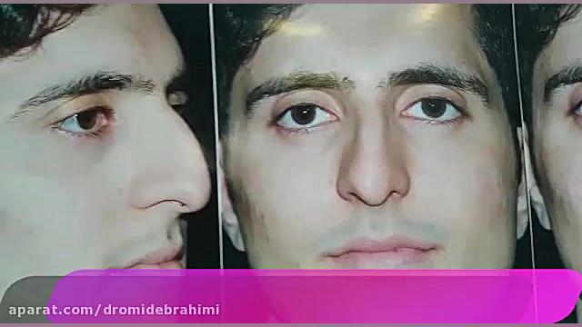جراحی زیبایی بینی توسط بهترین جراح بینی طبیعی، دکتر امید ابراهیمی دکتر امید ابراهیمی
