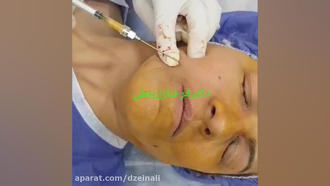 تزریق چربی گرفته شده از شکم به صورت دکتر فرحناز زینعلی - متخصص پوست، مو، زیبایی زنجان