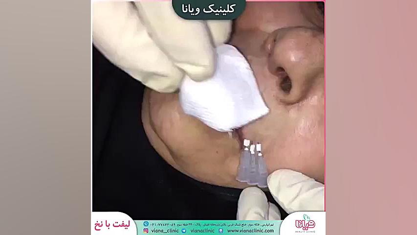 لیفت صورت با نخ - جوان سازی و از بین رفتن چروک سیستم ارزیابی هیستوترمیک