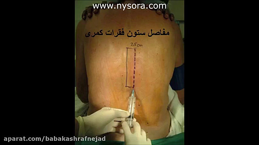 اوزون درمانى در ارتروز زانو دکتر بابک اشرف نژاد