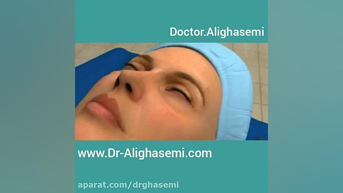 جراحی زیبایی پلک 4 دکتر علی قاسمی(پوست ، مو ، زیبایی )
