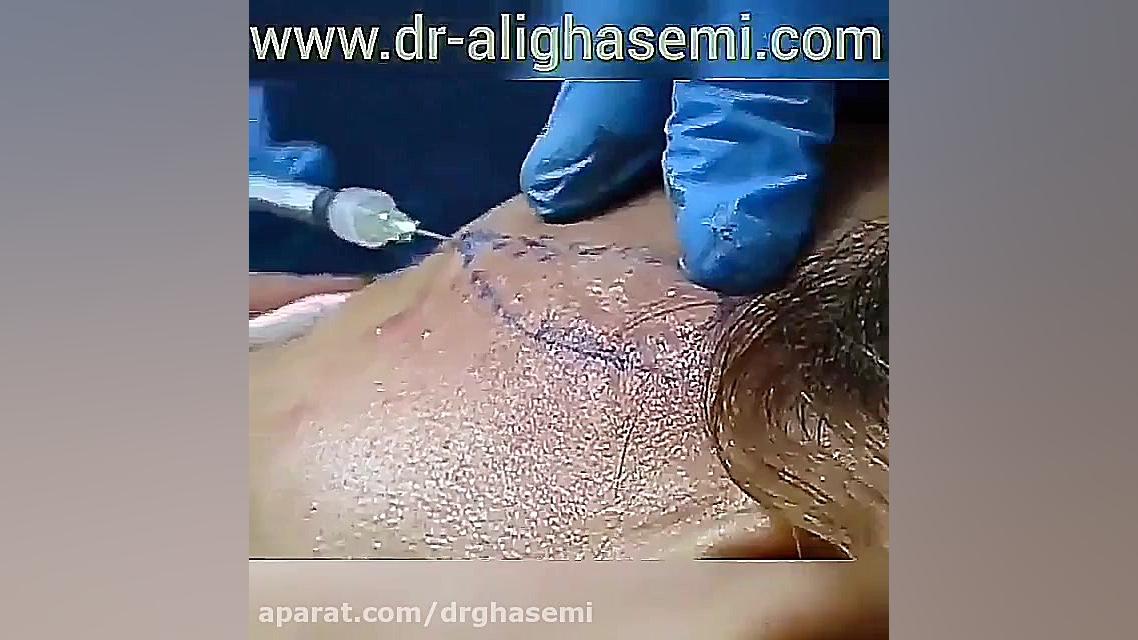 تزریق ژل به گونه دکتر علی قاسمی(پوست ، مو ، زیبایی )