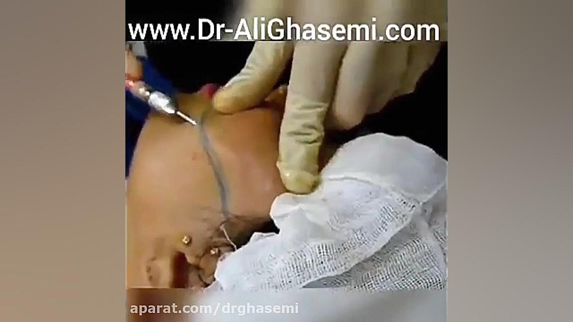 تزریق چربی به گونه دکتر علی قاسمی(پوست ، مو ، زیبایی )
