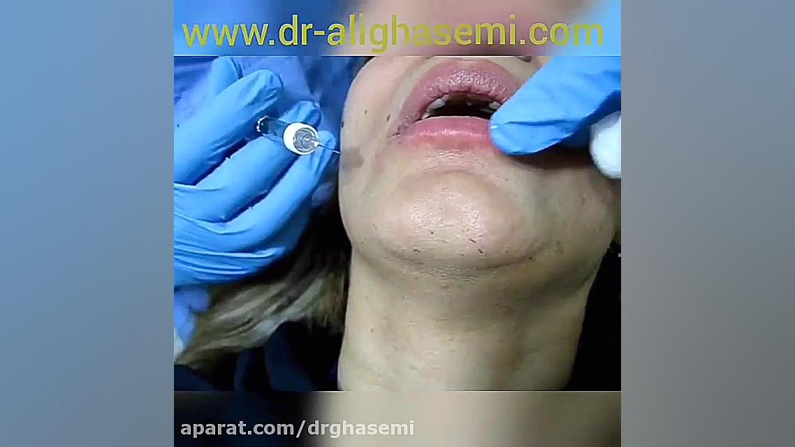 تزریق ژل به لب دکتر علی قاسمی(پوست ، مو ، زیبایی )