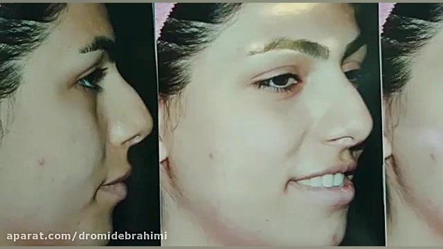 جراحی زیبایی بینی توسط بهترین جراح بینی طبیعی، دکتر امید ابراهیمی دکتر امید ابراهیمی