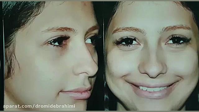 جراحی زیبایی بینی توسط بهترین جراح بینی طبیعی، دکتر امید ابراهیمی دکتر امید ابراهیمی