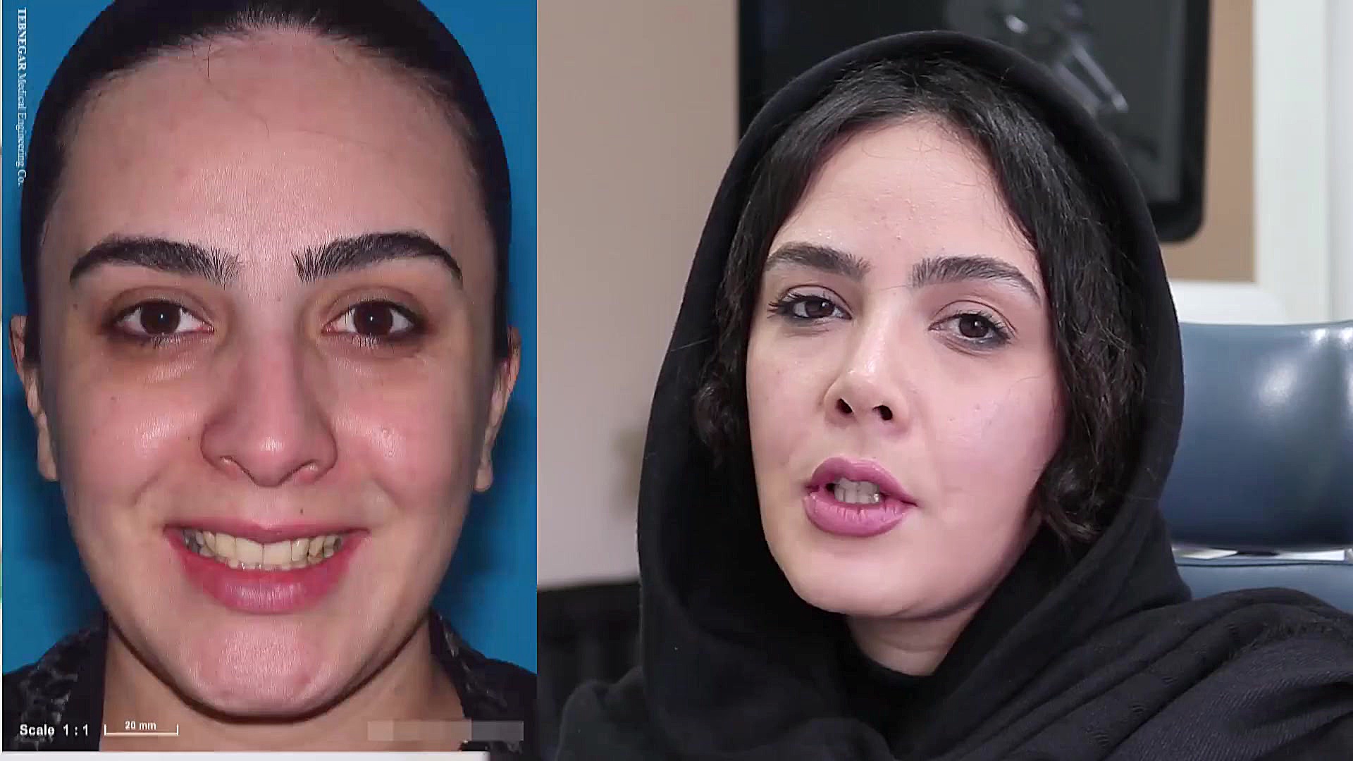 نمونه جراحی بینی توسط بهترین جراح بینی تهران دکتر محمد اسماعیل هادیزاده