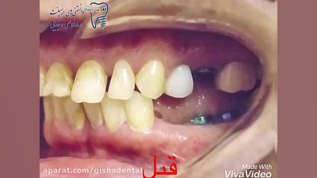 بازسازی دندانها با ایمپلنت و لامینیت سرامیکی کلینیک دندانپزشکی دکتر عزیز گشاده رو